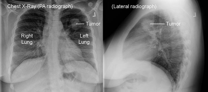 Chest x-ray