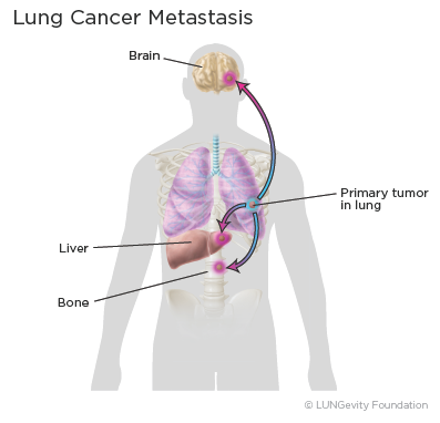 Lung cancer metastasis illustration