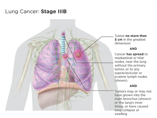 Lung Cancer Staging Lungevity Foundation