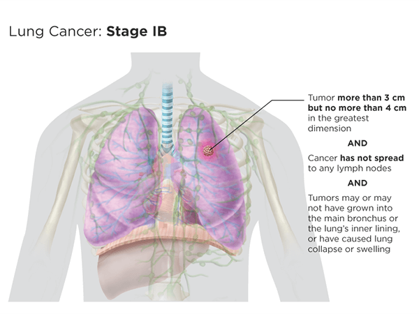Lung cancer: stage Ib