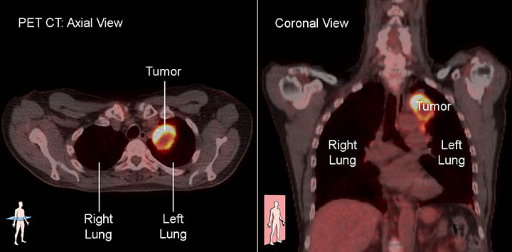 Combined PET-CT scan