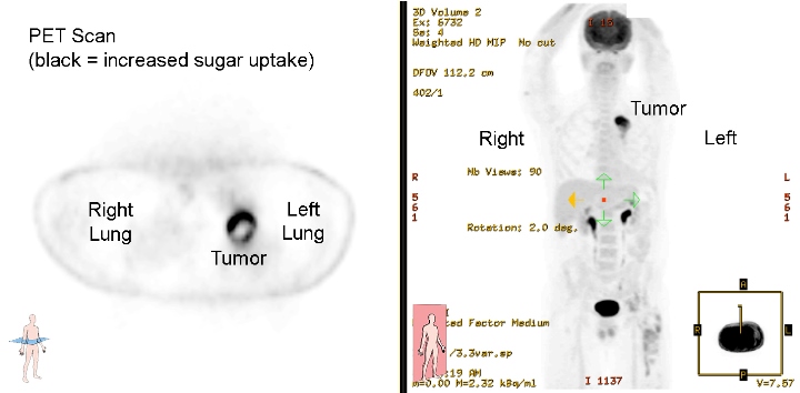 PET scan