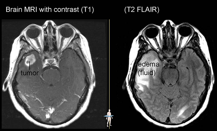 When are CT scans used versus MRI scans?