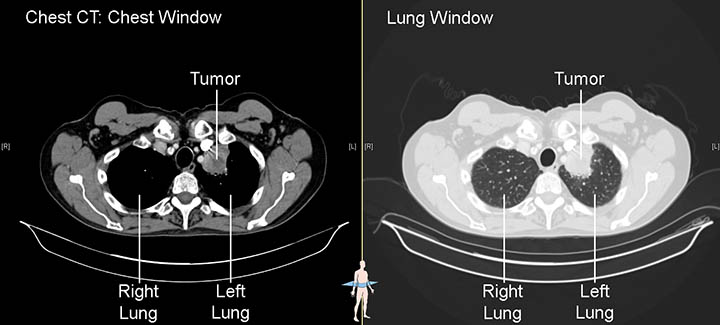 Chest CT scan