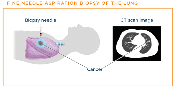 Fine needle aspiration bioipsy of the lung