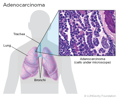 Adenocarcinoma of the lung