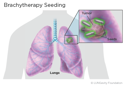 Seed implantation Seed implantation