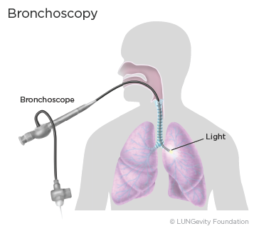 Bronchoscopy illustration