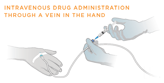 Intravenous drug administration in hand vein