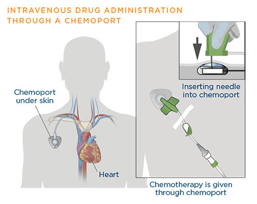 Drug administered through a port