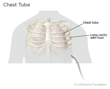 Chest tube