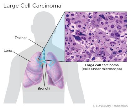 Large cell lung cancer