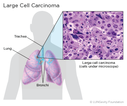 Large Cell Lung Carcinoma: Symptoms, Treatment, and More