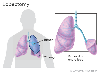 Lobectomy