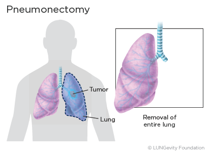 Pneumonectomy