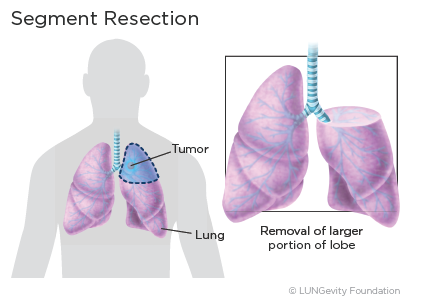 Segment resection