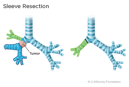 Sleeve resection