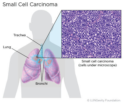 Small cell lung cancer (SCLC)