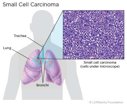 What is non-small cell carcinoma?