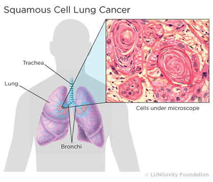 Squamous cell lung cancer