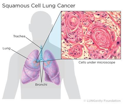 mesothelioma test