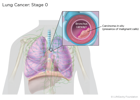 Lung cancer: stage 0