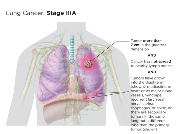 Stage IIIa version 1