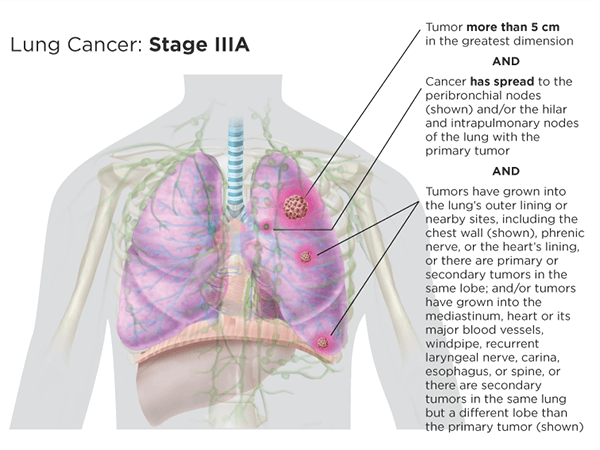 Stage IIIa version 2