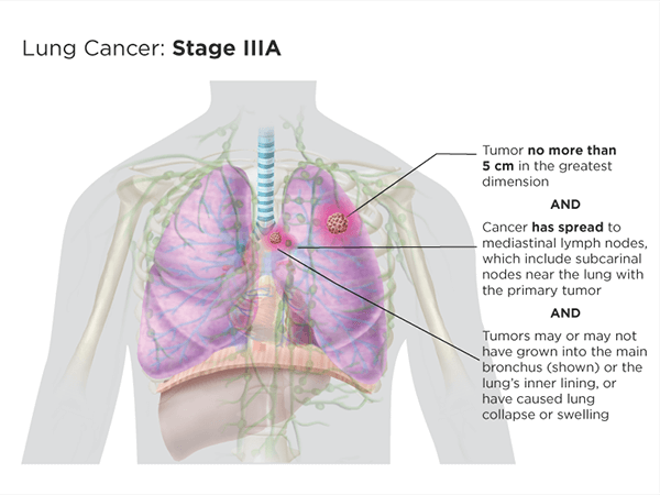 Stage IIIa version 3