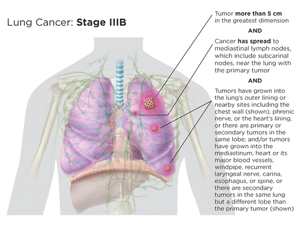 Stage IIIb version 1