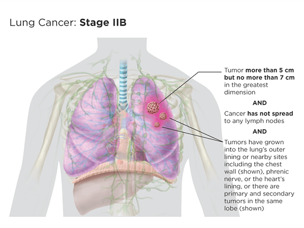 Stage IIb version 1