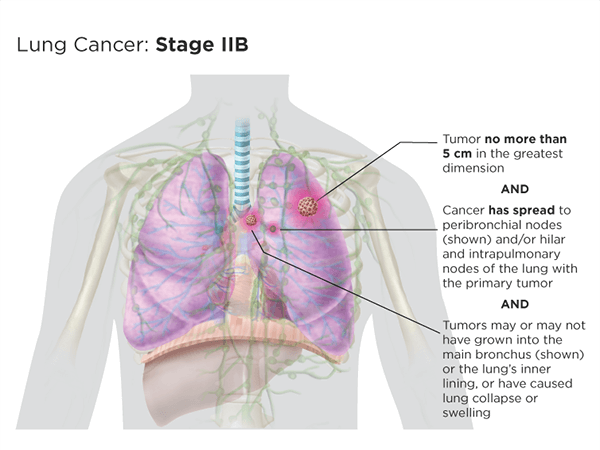 Stage IIb version 2