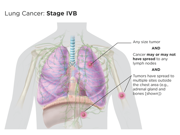 Lung cancer: stage IV
