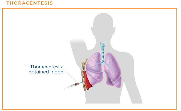 Thoracentesis