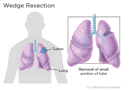 Wedge resection